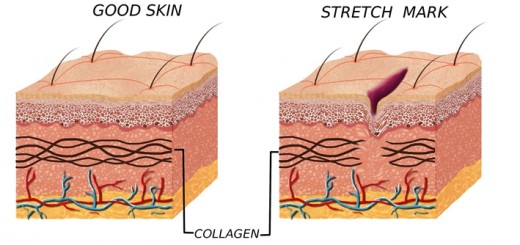 normal and stretched skin_New_Love_Times