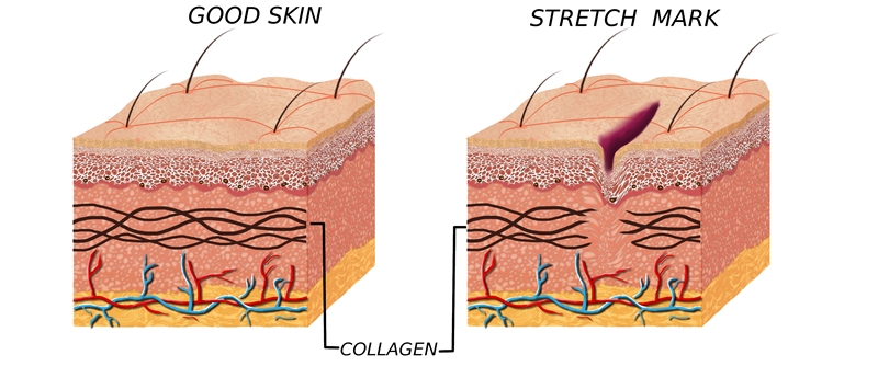 normal and stretched skin