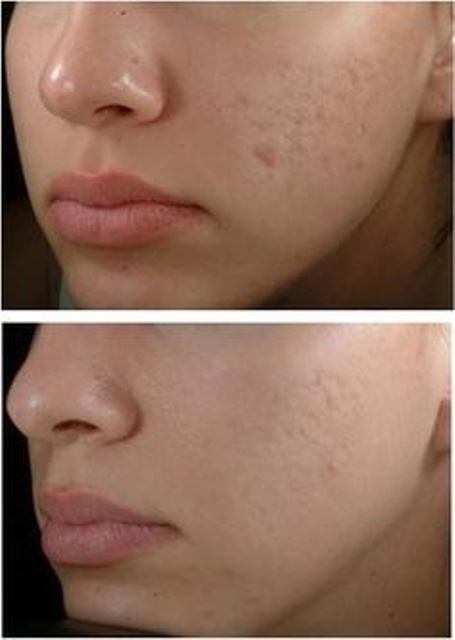 acne scars_New_Love_Times