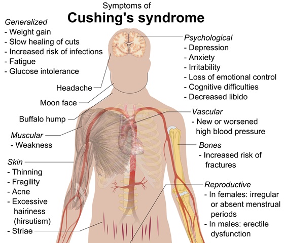 cushing's syndrome_New_Love_Times