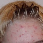 #ScienceSpeaks People With Acne Look Younger And Live Longer!