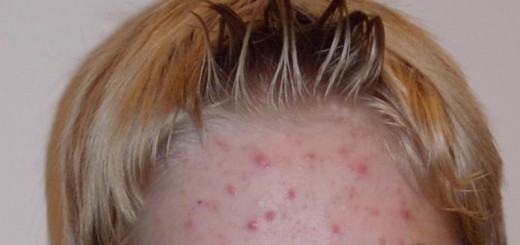 acne vulgaris_New_Love_Times