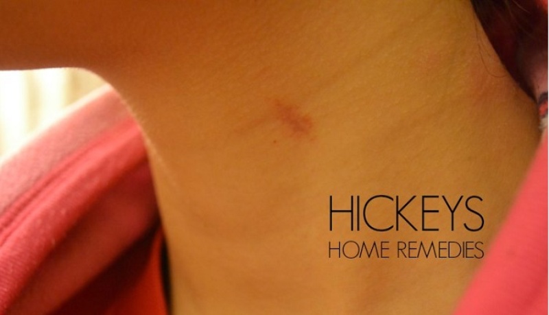 Take how hickies to out A Step