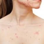 9 Glaring Mistakes You Must Avoid To Prevent Body Acne