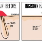 14 Effective Home Remedies For Ingrown Hair That Work Wonders