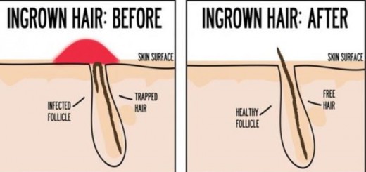 ingrown hair