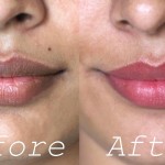 14 Invaluable Home Remedies To Lighten Dark Lips