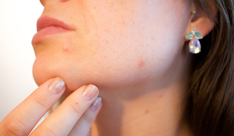 # Brown Spots On Neck Diabetes - Diabetes Type 2 Normal Range