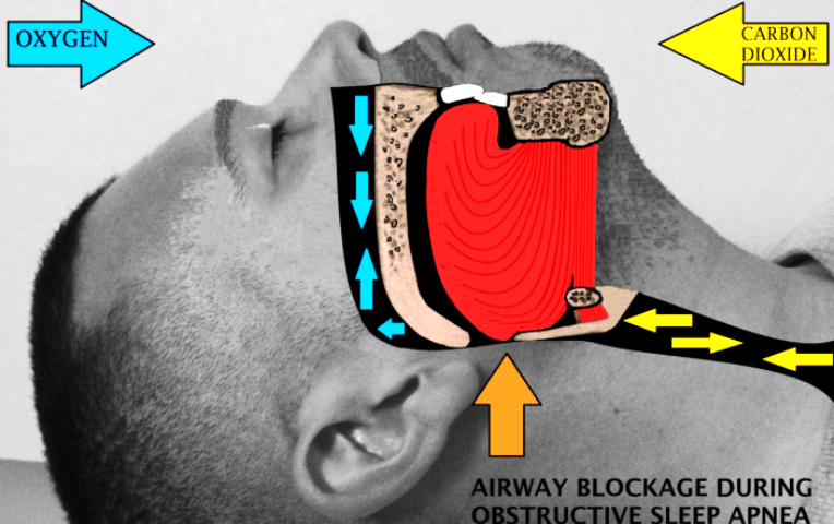 home-remedies-for-sleep-apnea_New_Love_Times