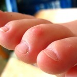 9 Superbly Effective Home Remedies For Calluses On Feet