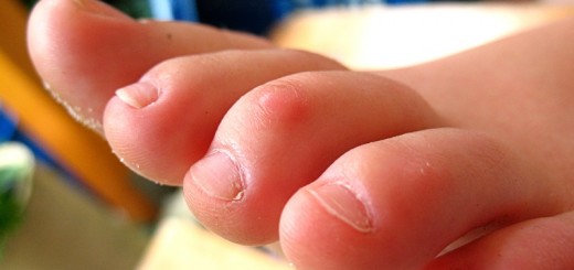 home remedies for calluses on feet_New_Love_Times
