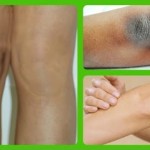 11 Superbly Effective Home Remedies For Dark Elbows And Knees