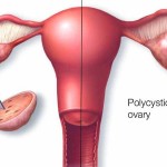 All You Need To Know About PCOS And How To Treat It With Home Remedies