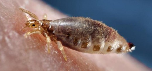 home remedies body lice_New_Love_Times