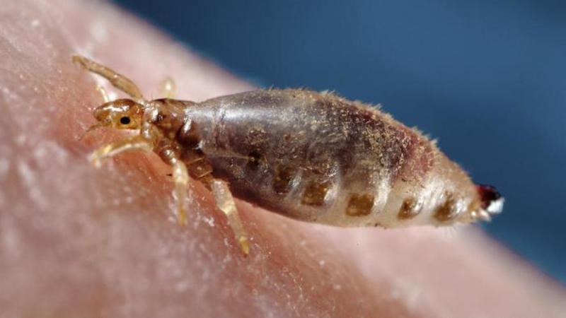 home remedies body lice_New_Love_Times