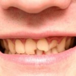 The Most Effective Home Remedies For Taking Care Of A Cracked Tooth