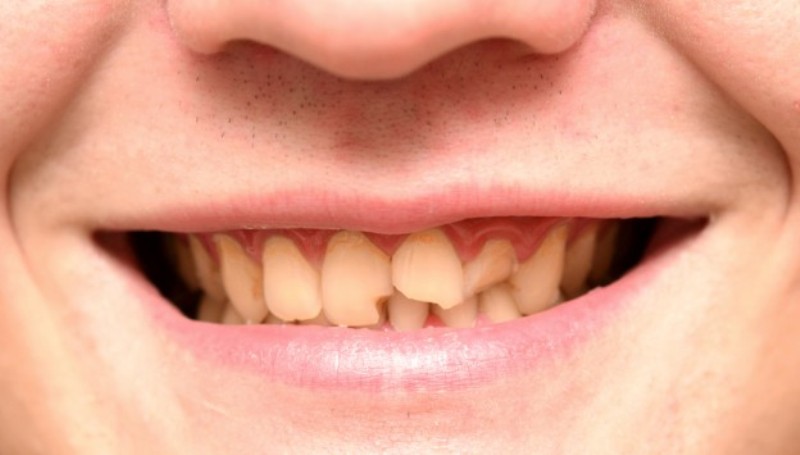 cracked tooth home remedies_New_Love_Times