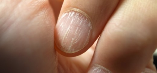 home remedies for brittle nails_New_Love_Times