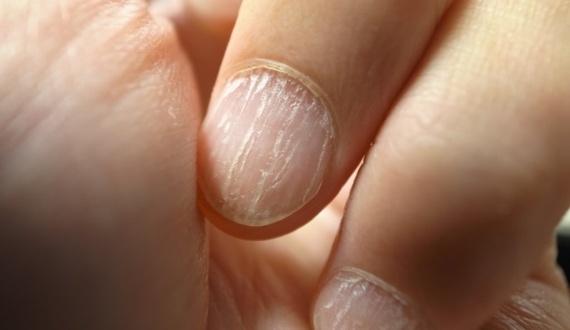 home remedies for brittle nails_New_Love_Times