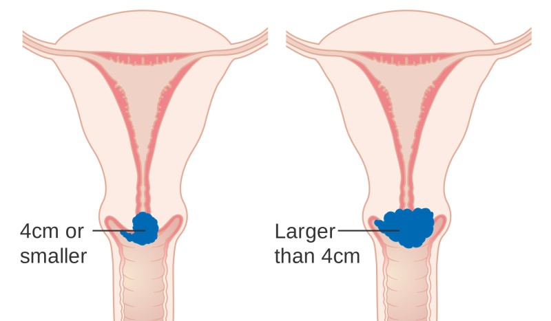 warning signs of cervical cancer_New_Love_Times