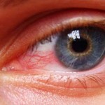 The Top 10 Home Remedies For Eye Strain