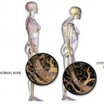 Here Are Top 10 Natural Home Remedies For Osteoporosis