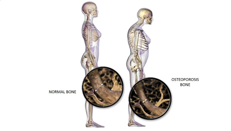 home remedies for Osteoporosis_New_Love_Remedies