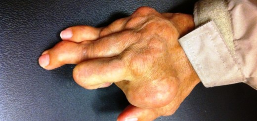 home remedies for rheumatoid arthritis_New_Love_Times