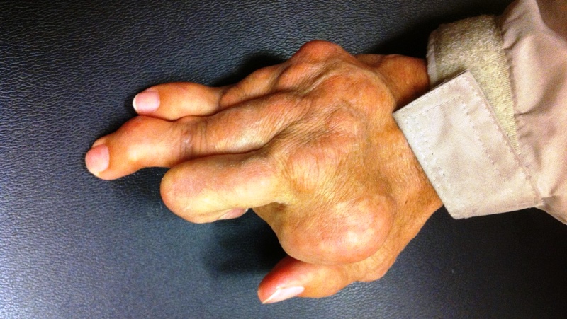 home remedies for rheumatoid arthritis_New_Love_Times