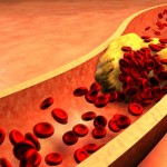 Here Are The Top Home Remedies For Clogged Arteries