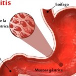 Here Are The Top Home Remedies For Gastritis