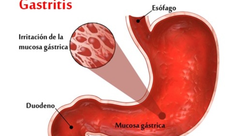 gastritis_New_Love_Times