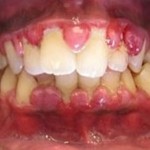 The Most Effective Home Remedies For Gingivitis