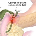8 Best Home Remedies for Gallbladder Pain