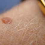 13 Highly Effective Home Remedies To Get Rid Of Unattractive Moles