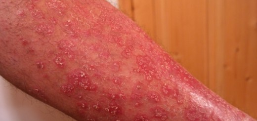 home remedies for psoriasis_New_Love_Times