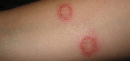 home remedies for ringworm_New_Love_Times