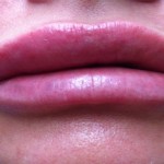 13 Of The Most Effective Home Remedies For Swollen Lips