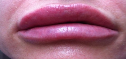 home remedies for swollen lips_New_Love_Times