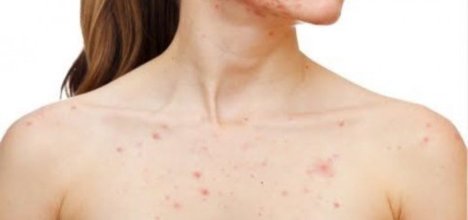 home remedies for chest acne_New_Love_Times