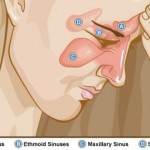 All You Need To Know About Treating Acute Sinusitis With Home Remedies