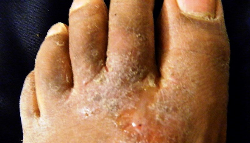 Home remedies for athlete's foot itch_New_Love_Times