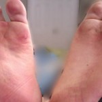 9 Excellent Home Remedies For Foot Blisters That Help Get Rid Of Them