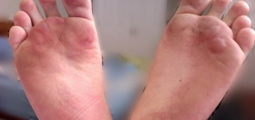 home remedies for foot blisters_New_Love_Times