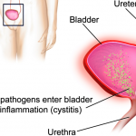 10 Best Natural Treatments For Bladder Infection