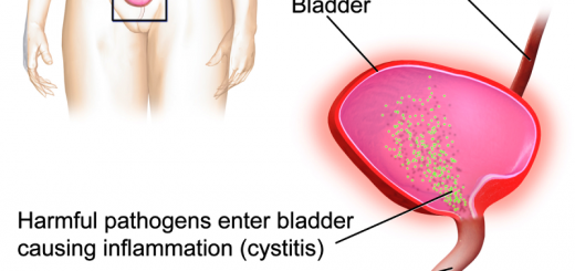 home remedies for bladder infection_New_Love_Times