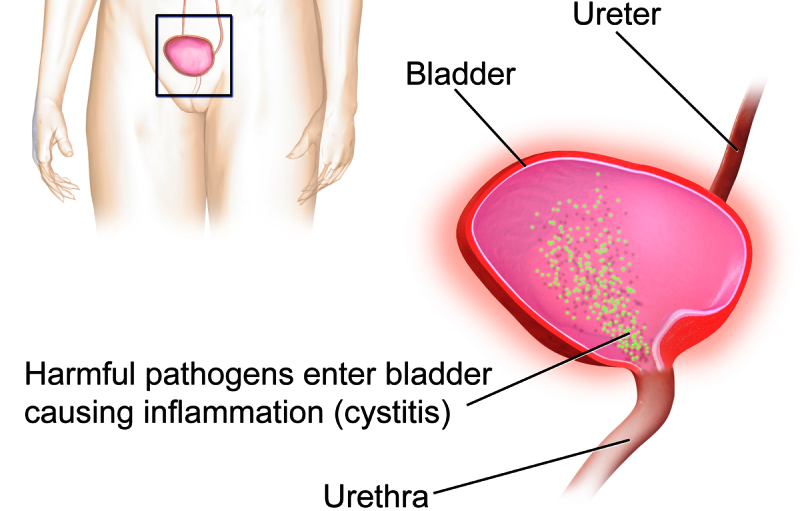 home remedies for bladder infection_New_Love_Times