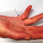 Here Are 8 Home Remedies That Will Help You Deal With Trigger Finger