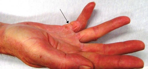 home remedies for trigger finger_New_Love_Times