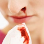12 Most Effective Home Remedies For Nosebleeds